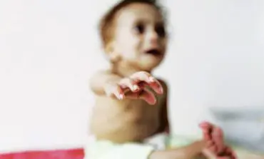 Minister: Half of Yemen's children are malnourished