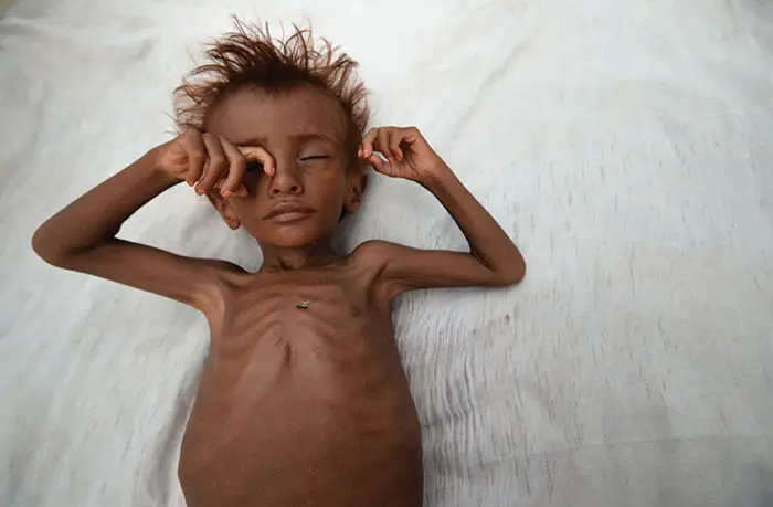 The war in Yemen must end, as famine spreads