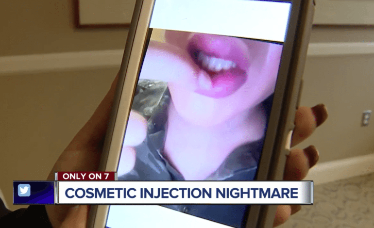 Woman's lips injected with non-FDA approved product at Dearborn Heights salon