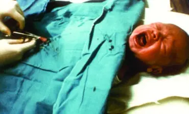 Male circumcision: Outdated tradition or necessary medical procedure?