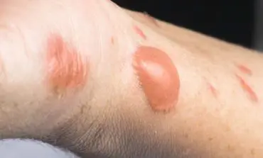 Safety tips for July 4th: Preventing firework burns