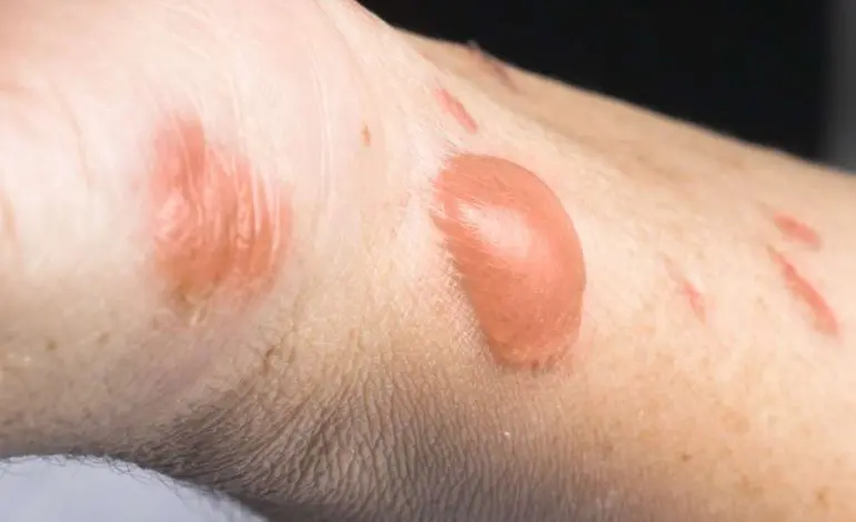 Safety tips for July 4th: Preventing firework burns