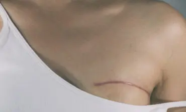 Women with breast cancer needed for study