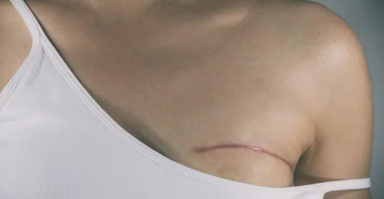 Women with breast cancer needed for study