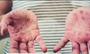 Measles outbreak in Oakland County sees five more confirmed cases