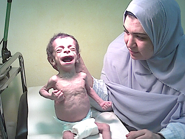 Youssef, an Egyptian boy with CF, is almost two years old, but appears to be a starving newborn. He weighed 6.6 pounds. Youssefs parents lost several kids to CF before he was born because they had no idea their children had CF. Youssef was diagnosed by Dr. Maggie Naguib (Professor of pediatrics at Cairo, University, Egypt) and Dr. Nasr.