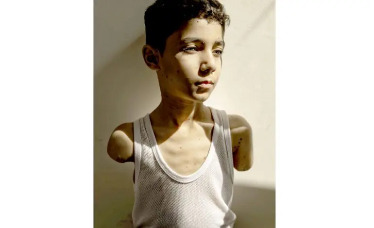 Portrait of Palestinian boy who lost both arms is World Press Photo of the Year