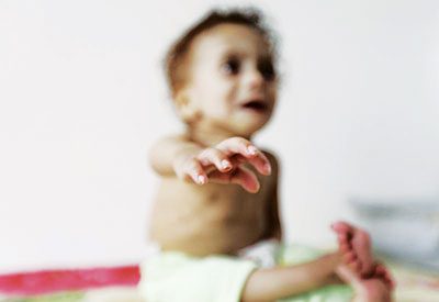 Minister: Half of Yemen’s children are malnourished