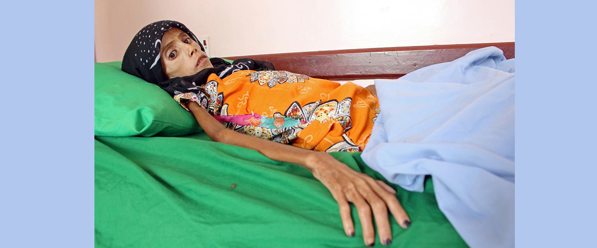 Starving Girl Shows Impact Of Yemen War Economic Collapse 