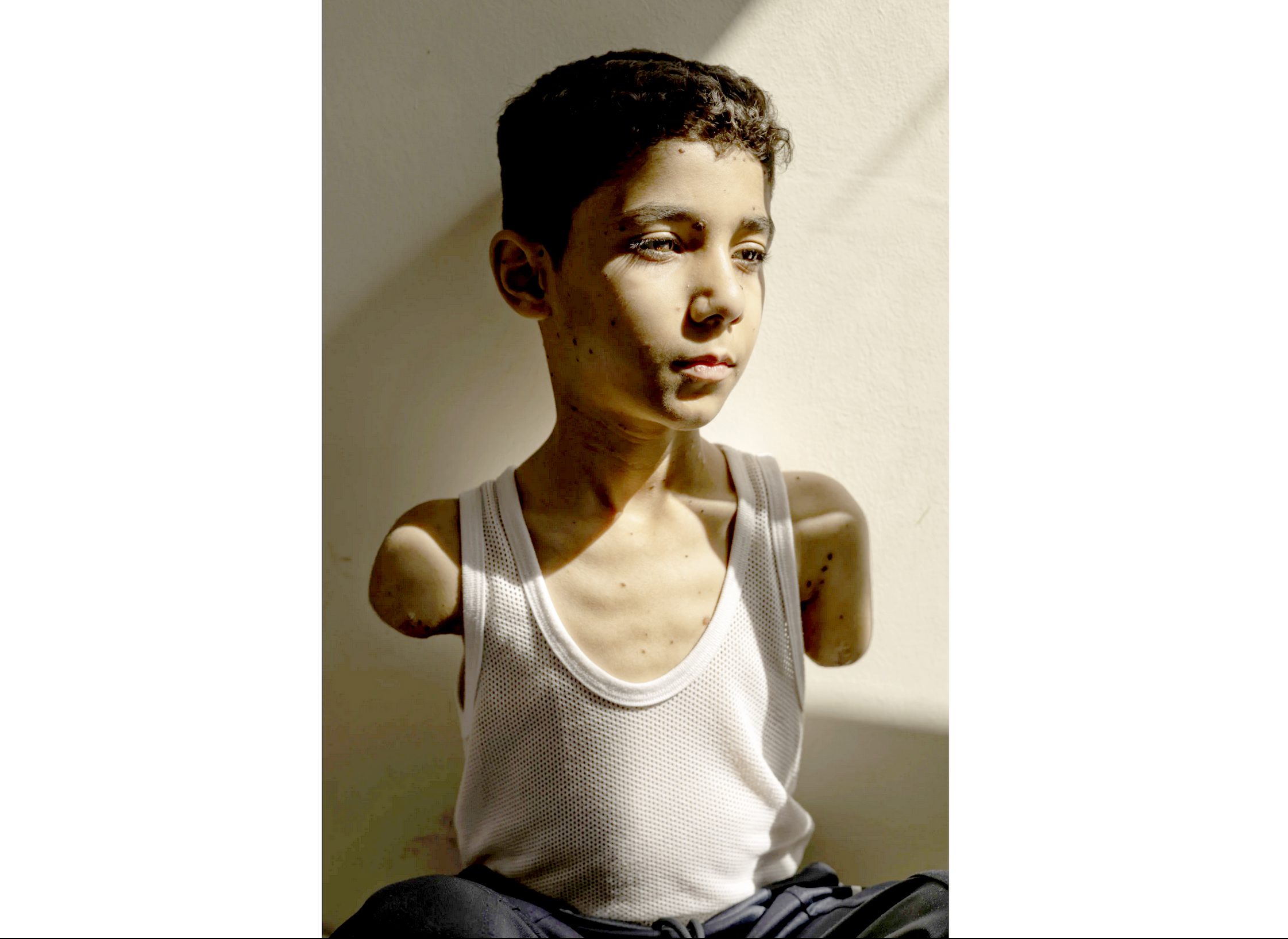 This image provided by World Press Photo and taken by Samar Abu Elouf, for The New York Times, won the World Press Photo Award of the Year. The photo shows Mahmoud Ajjour (9), who was severely injured during an Israeli assault on Gaza City in March 2024, finds refuge for medical treatment in Doha, Qatar, June 28, 2024.